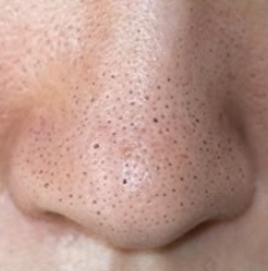 Blackheads